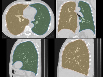 Example of 3D lung segmentation in CT scans 
